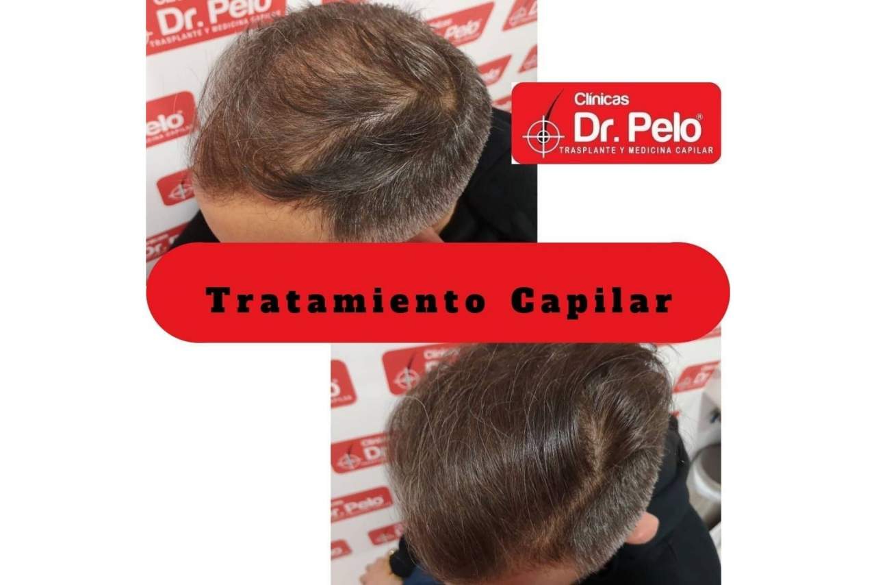 Opiniones sobre el injerto capilar de las Clínicas Dr. Pelo en Sevilla