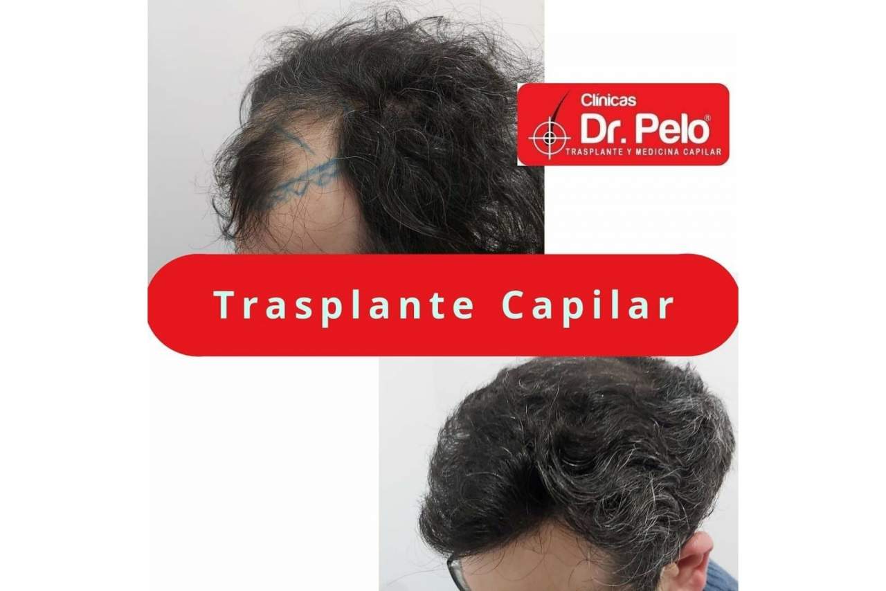 El transplante capilar gana popularidad en los últimos años en España tras mejorar los precios y las técnicas aplicadas