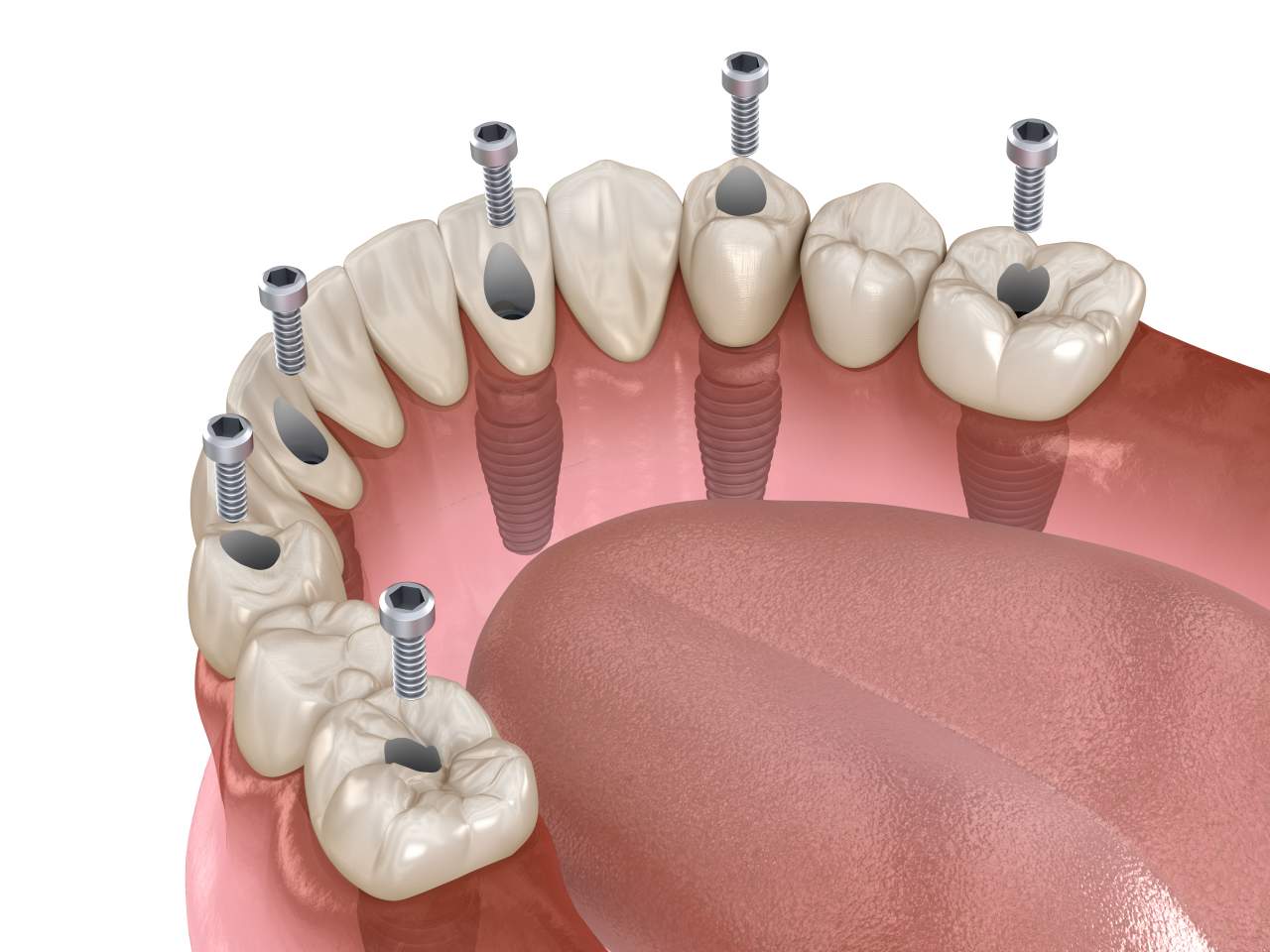 Dentistas de la Clínica Helident Sevilla: es recomendable el uso de la mejor calidad en implantes