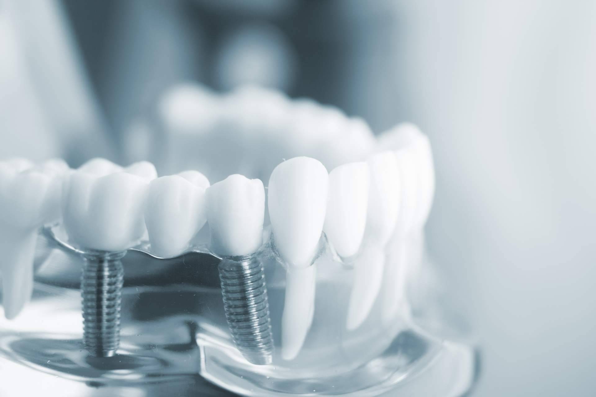 Tener dientes fijos en un solo día es posible gracias a los implantes dentales de titanio V de la Clínica Artydents en Madrid