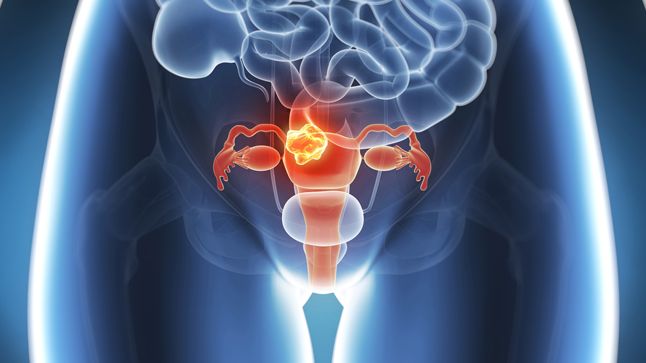 La mayoría de los casos de cáncer de útero en mujeres jóvenes se detectan durante los tratamientos de infertilidad