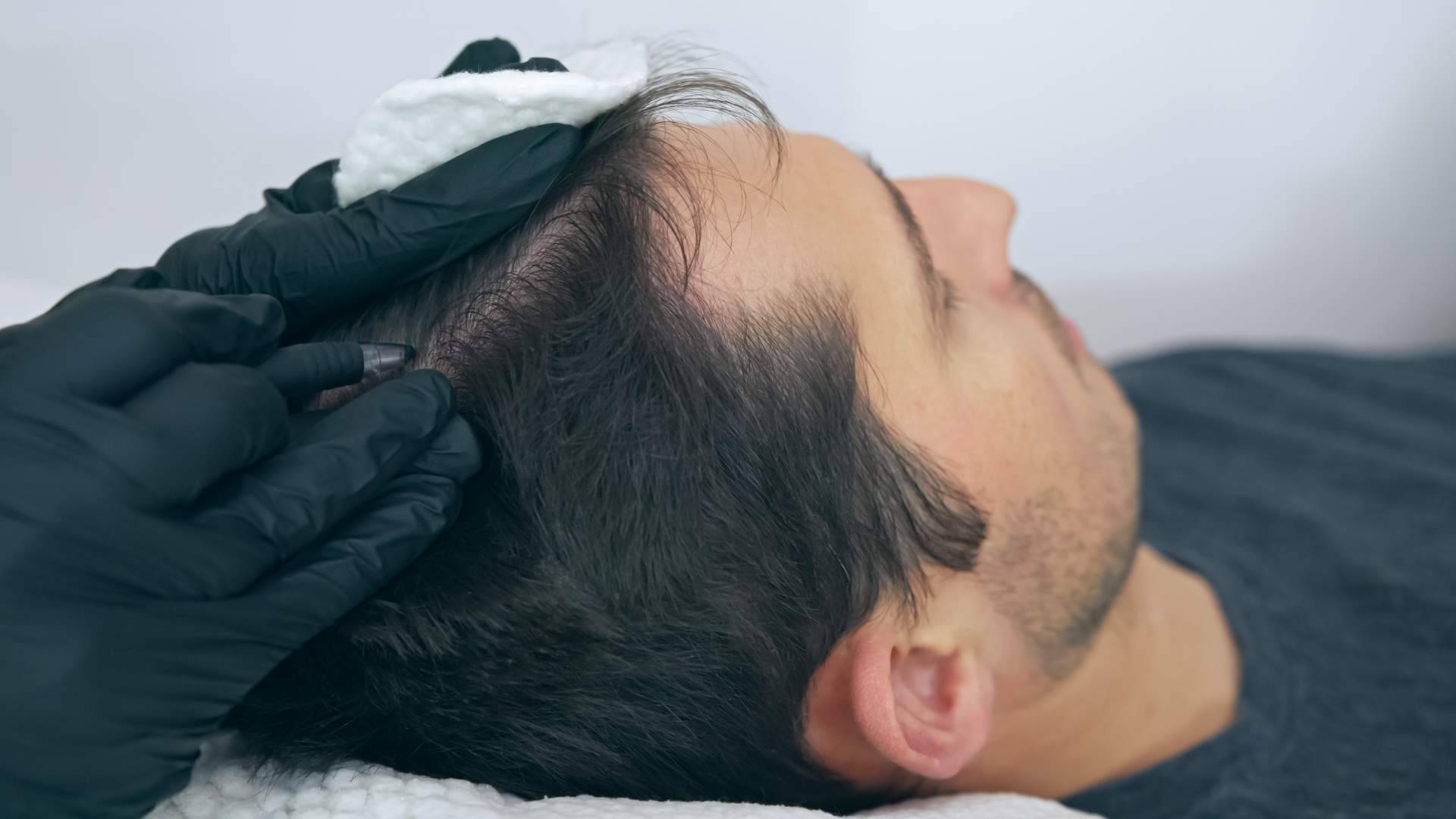 ¿Qué es la micropigmentación capilar?: Distrito Wellness Concept ofrece solución a los problemas de pérdida de cabello