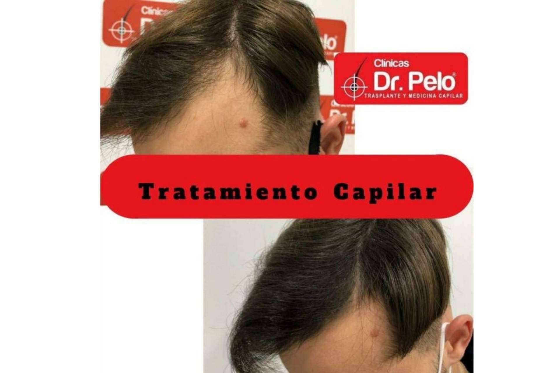 Mejores resultados de trasplante capilar en España gracias a la Clínica Dr. Pelo