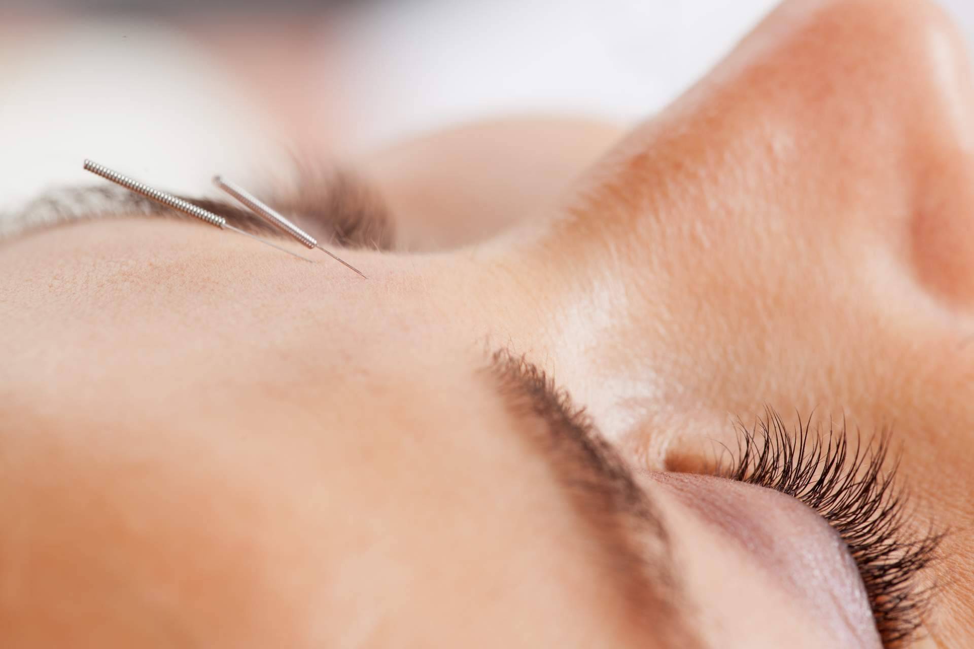 Realizar acupuntura estética a domicilio ya es posible gracias a Kikai