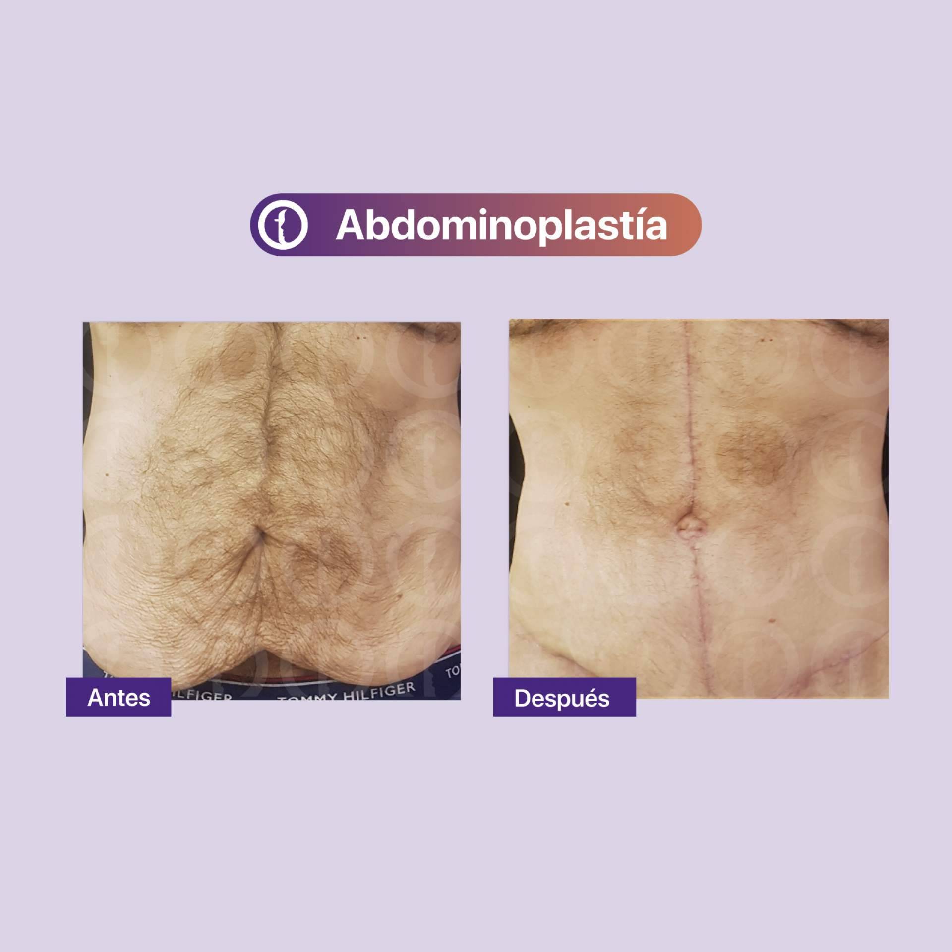La abdominoplastia de Clínica Tarrazo