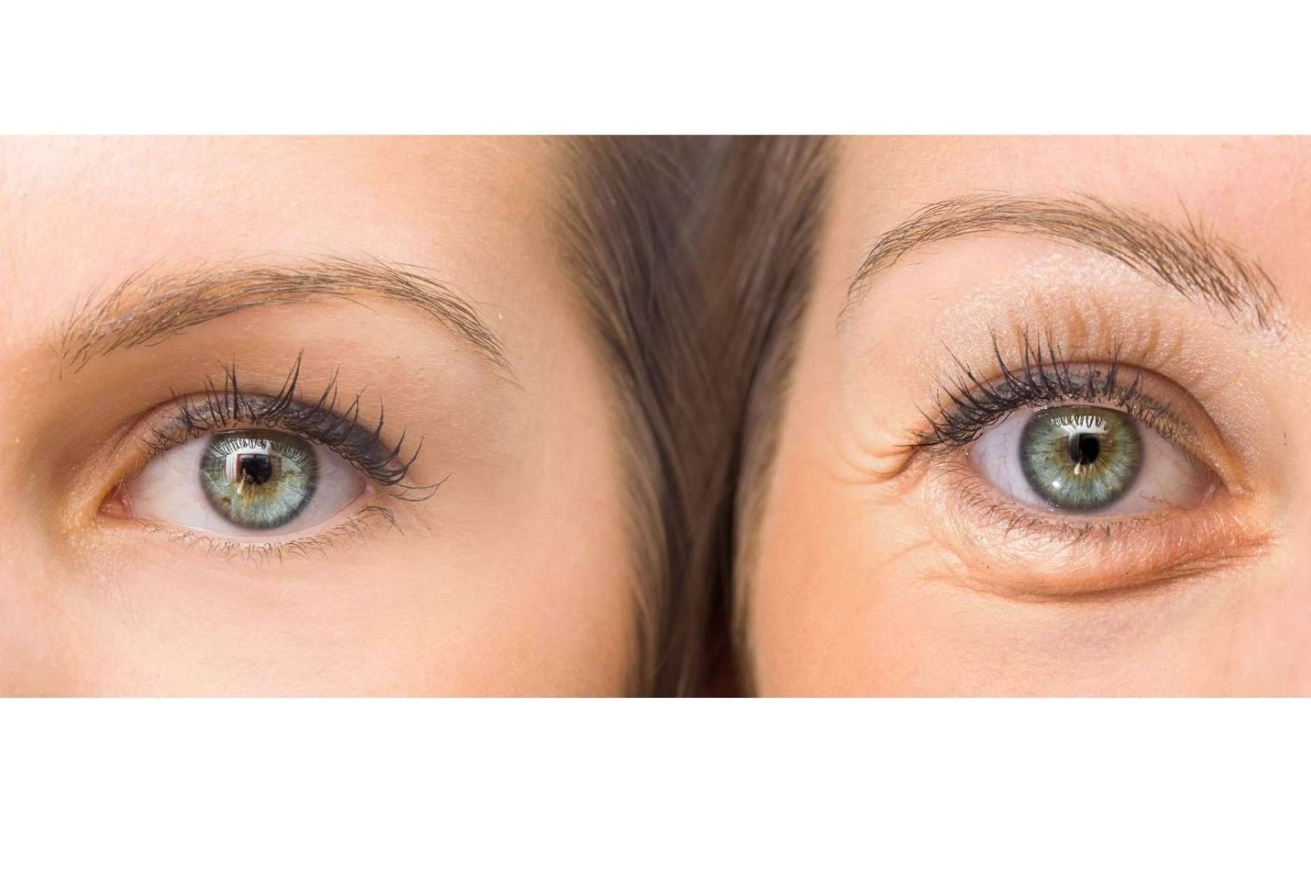 Ácido hialurónico para combatir las ojeras: Unidad de medicina estética FEMME de Santiago de Compostela con la Dra. Alfonsina Uriburu