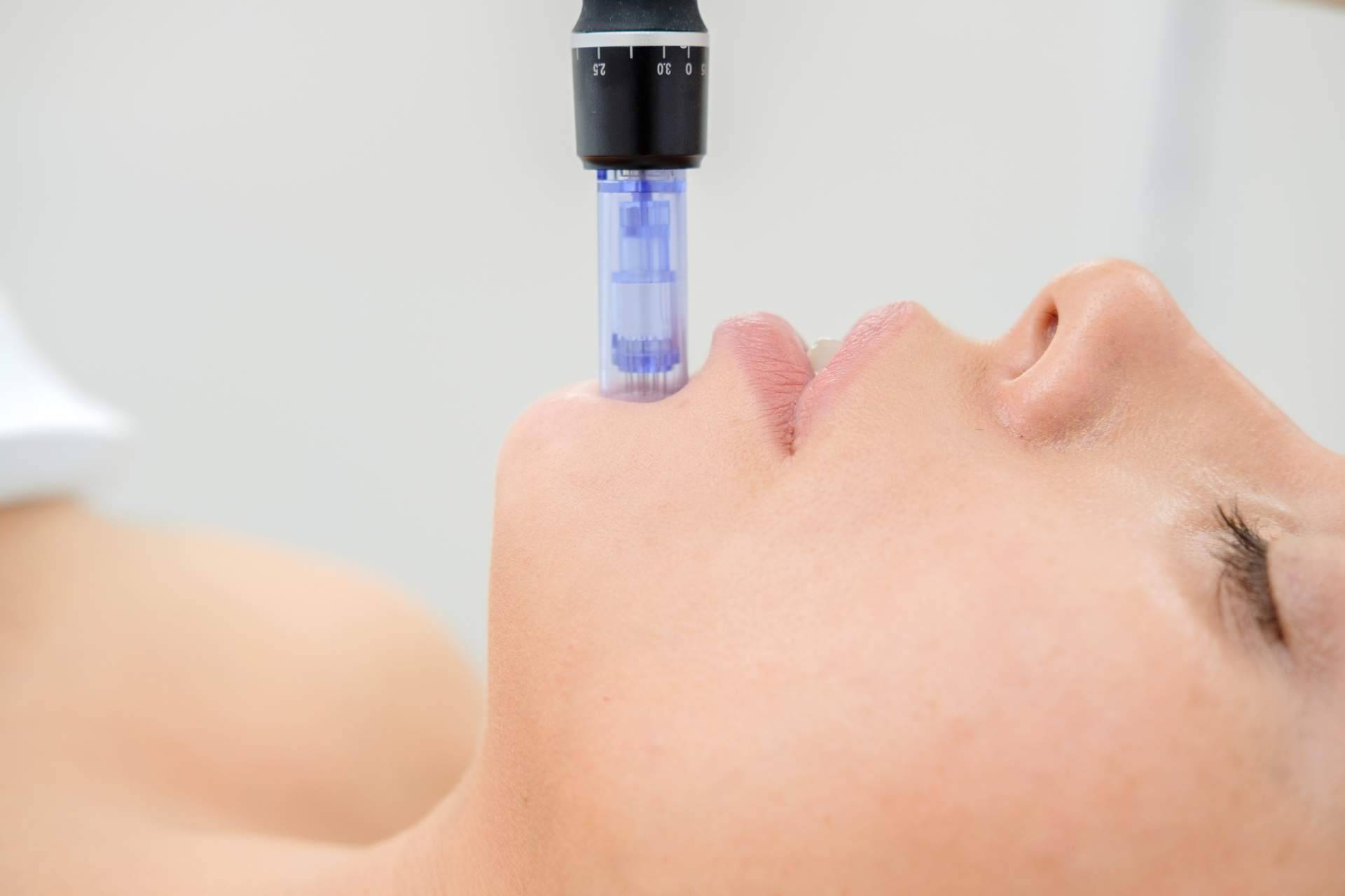 Los beneficios de la mesoterapia facial de VG Virginia Gómez