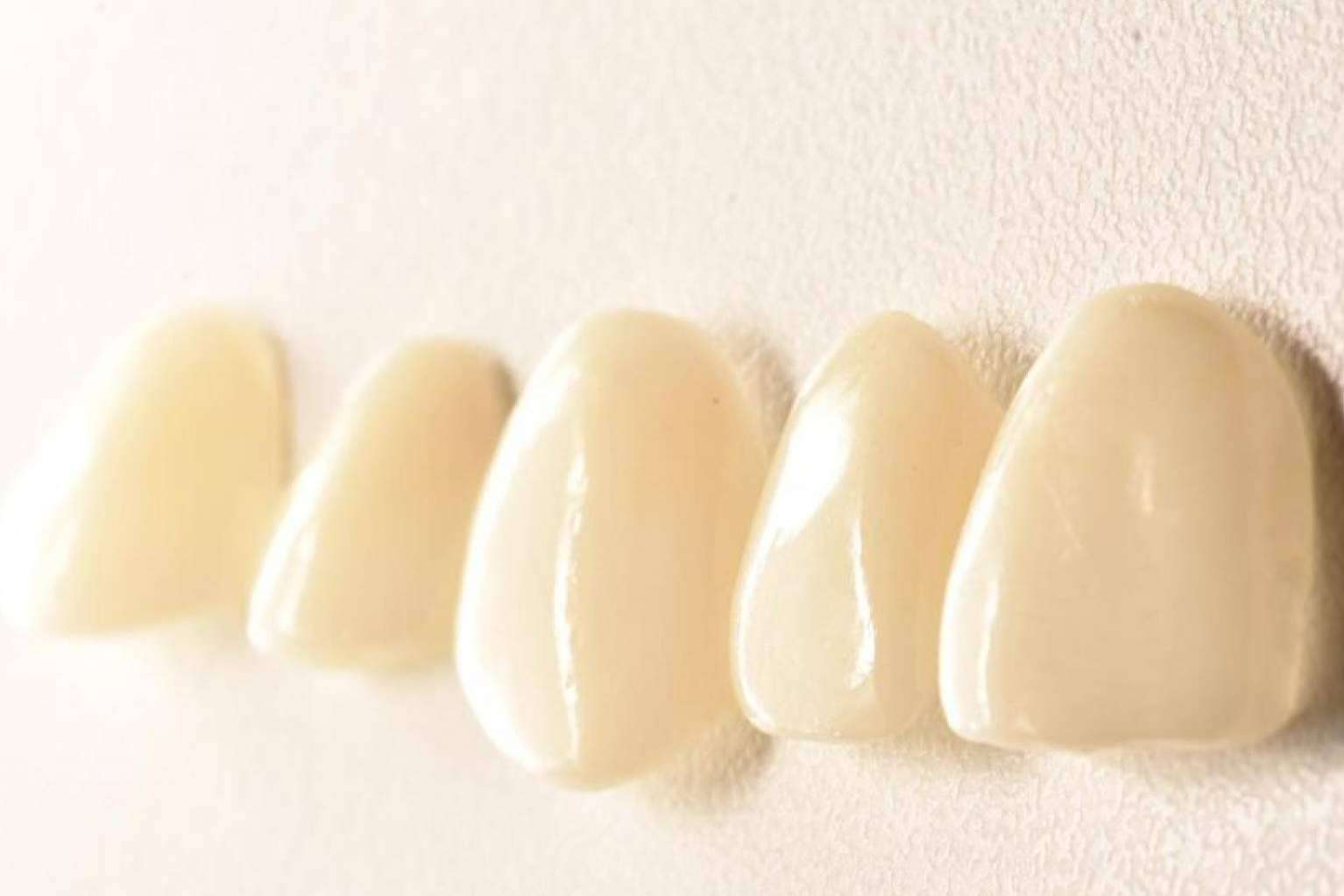 Las carillas Emax y las inyectadas de composite de Implant Clinics son tratamientos no invasivos que garantizan una sonrisa perfecta