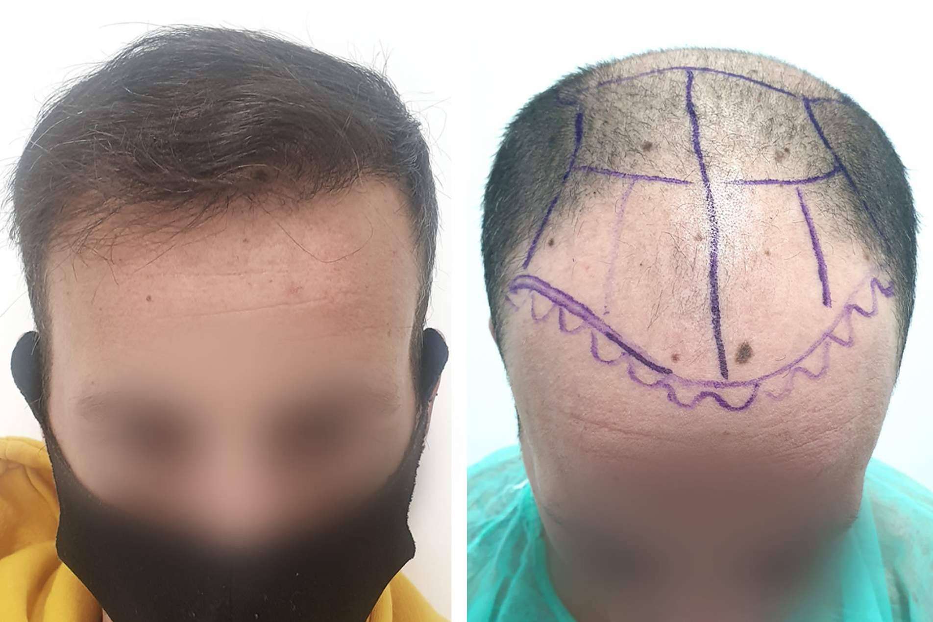 La clínica Injermur ofrece una técnica de injerto capilar que permite operaciones sin cicatriz