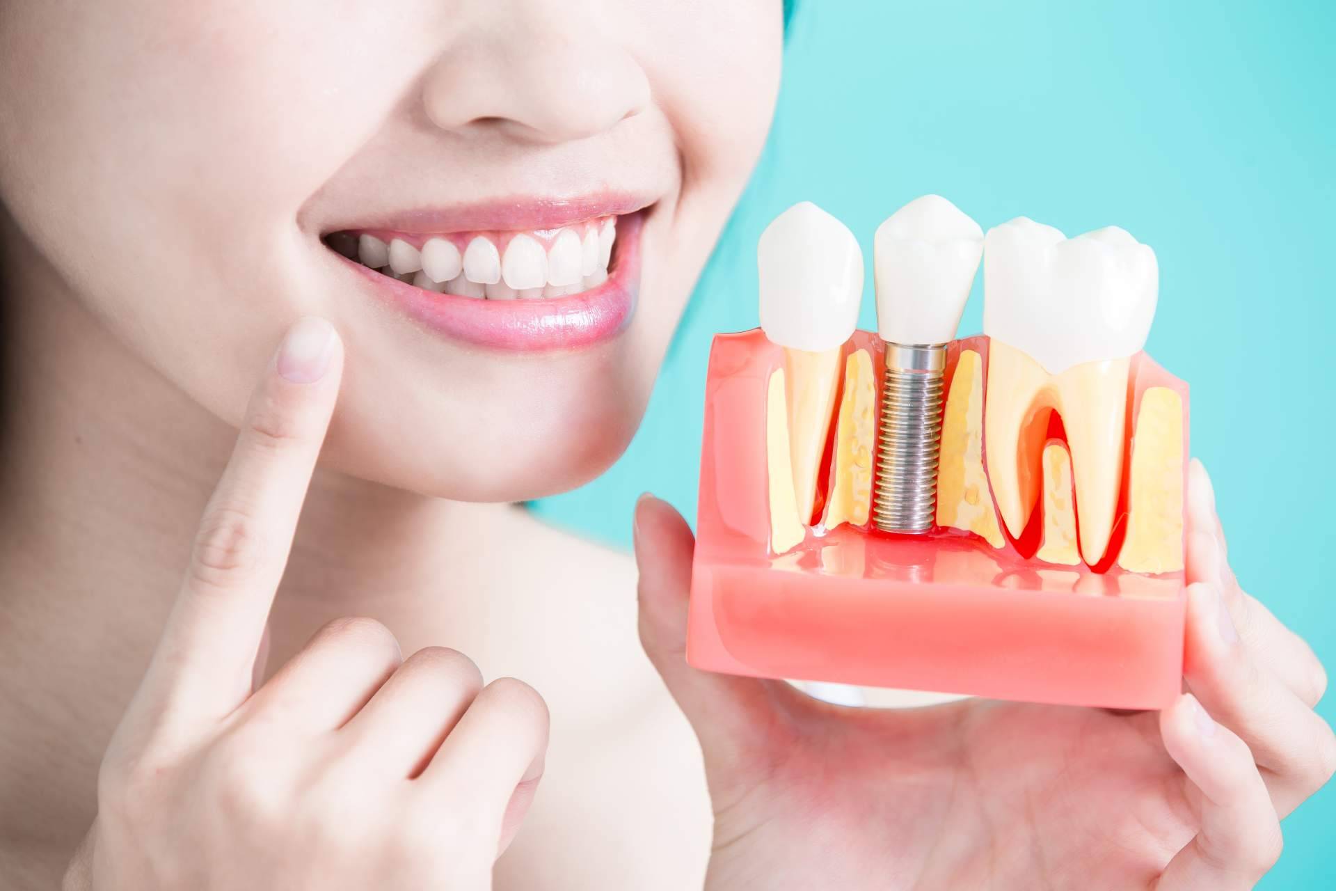 El tratamiento de implante dental de titanio en Sevilla realizado por Clínica Dental Helident