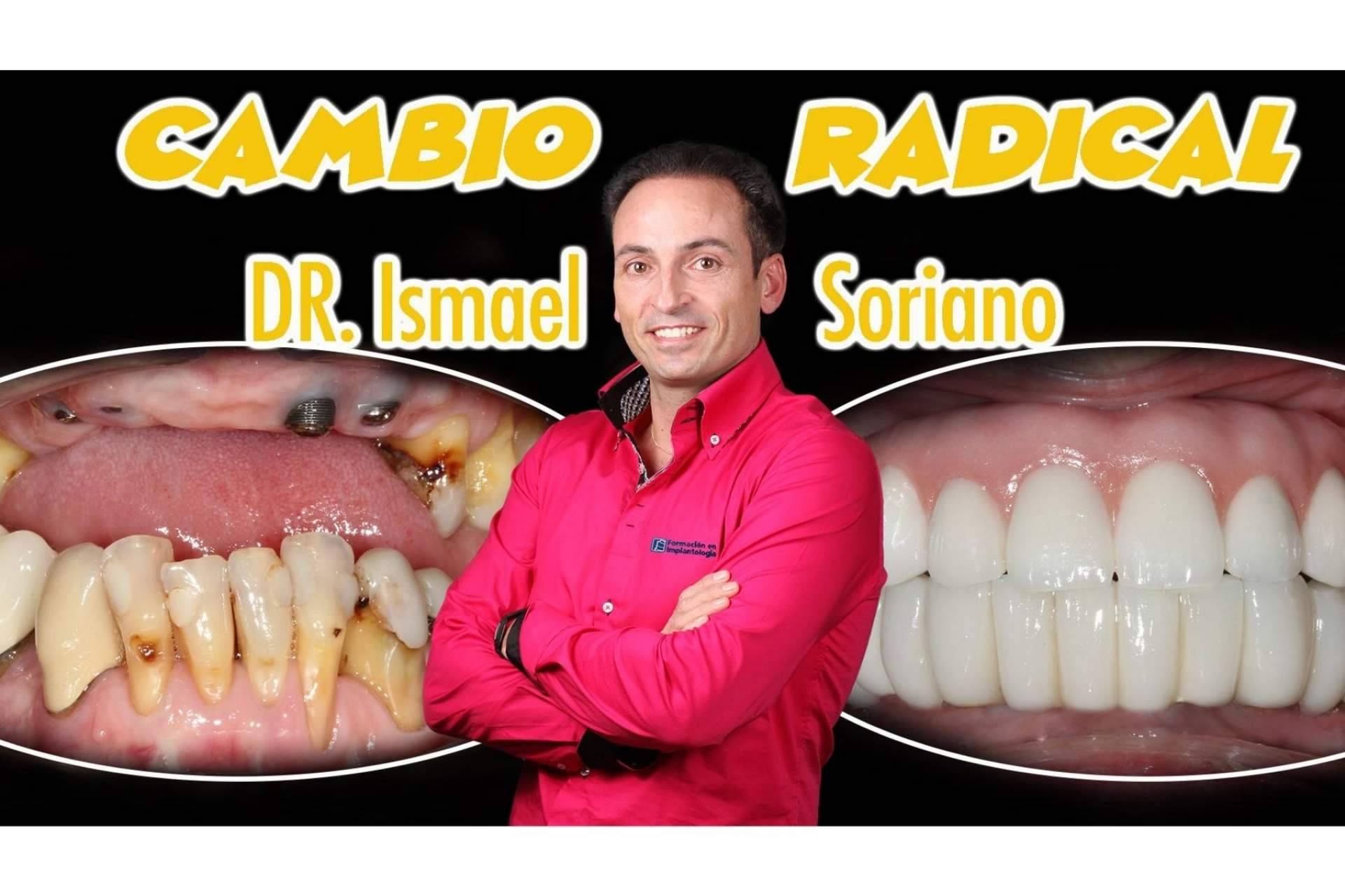 Implantes con dientes inmediatos, la técnica del Dr. Ismael Soriano que ofrece múltiples ventajas a los pacientes