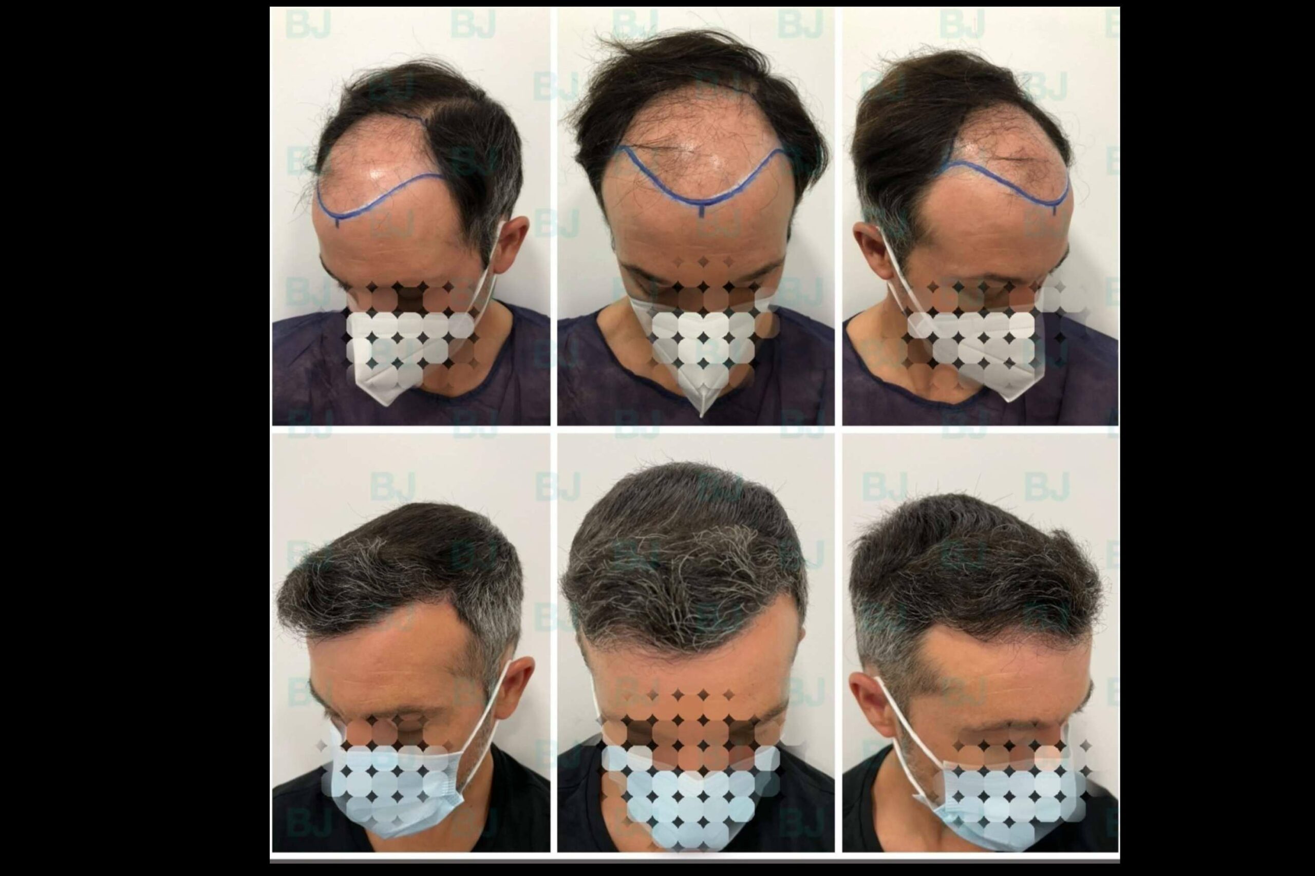 Dr. Bruno Jacobovski, el especialista en injerto capilar en Barcelona que ha logrado más de 500 intervenciones exitosas