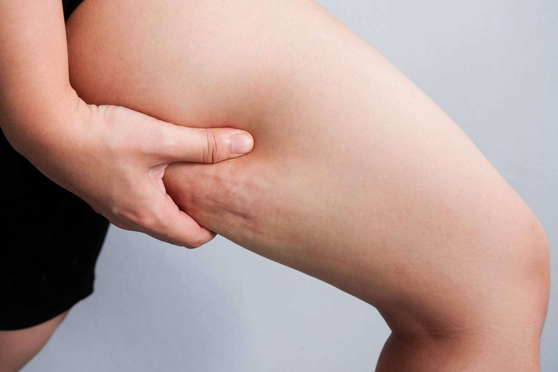 Combatir la celulitis de una forma natural es posible con Sincelut Forte