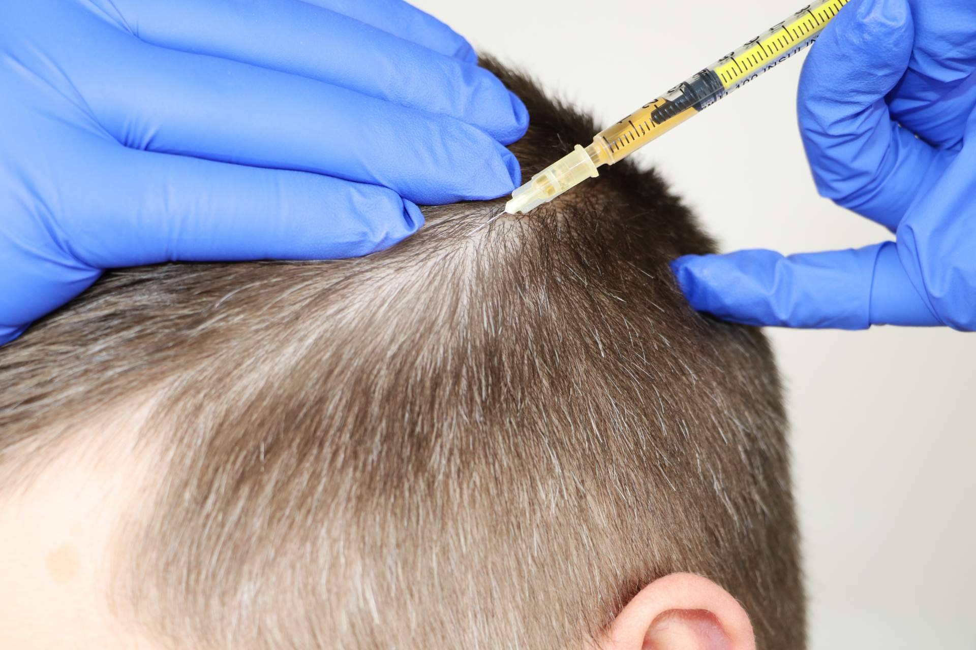 Los beneficios de la mesoterapia capilar de la mano del Dr. Bruno Jacobovski