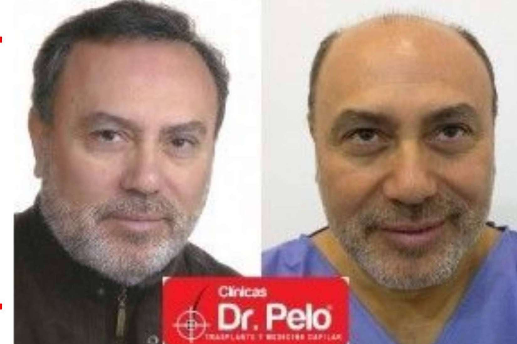 Clínicas Dr. Pelo, la importancia de conseguir trasplantes capilares con efecto natural