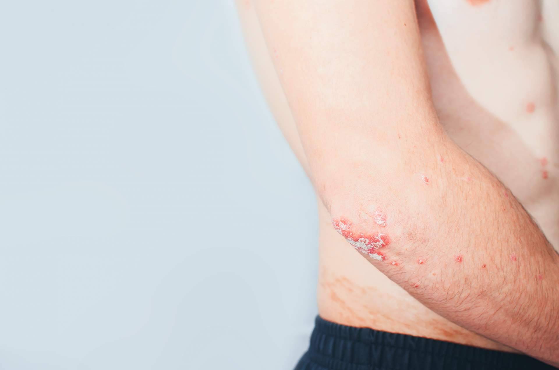 El tratamiento efectivo para la psoriasis de Soriasel