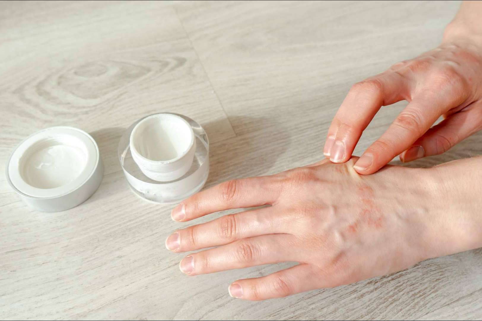 ¿Cómo se diferencia un eczema de contacto de un eczema atópico?, por Laboratorio Géomer