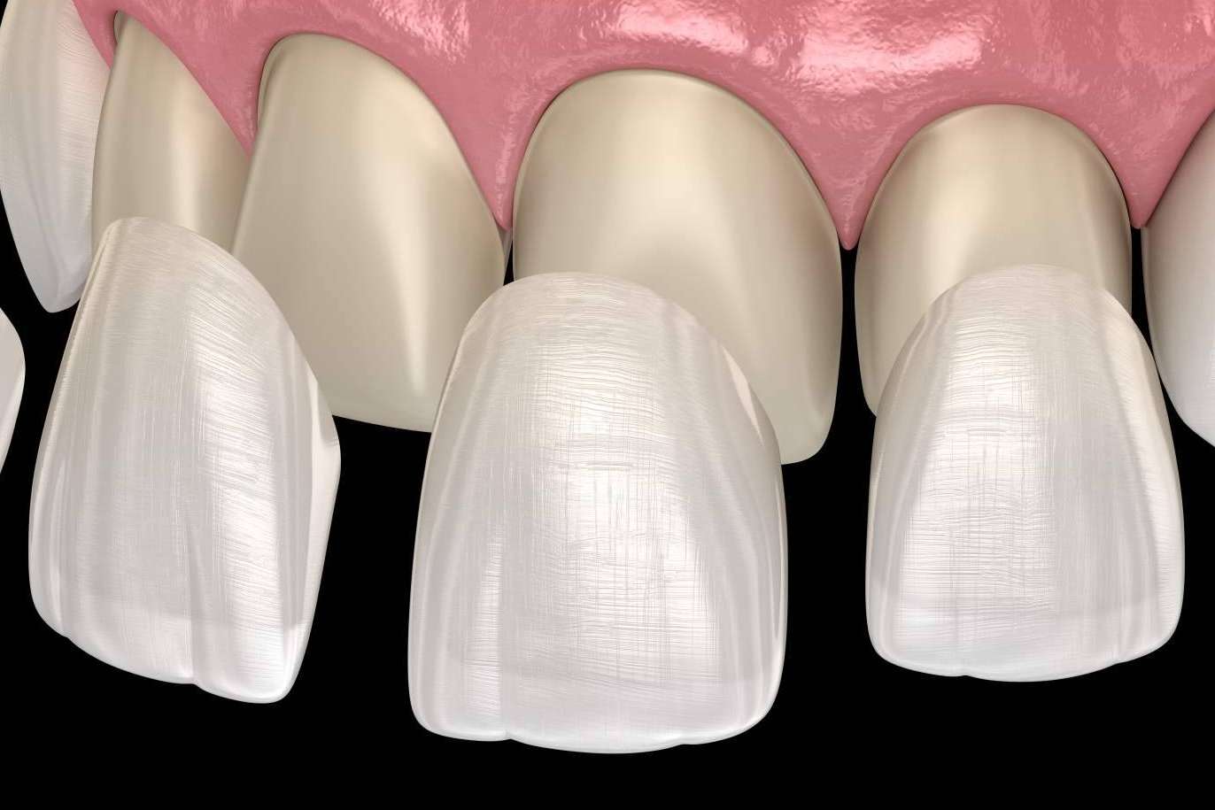 Conseguir una sonrisa Hollywood gracias a los servicios de Dentinova