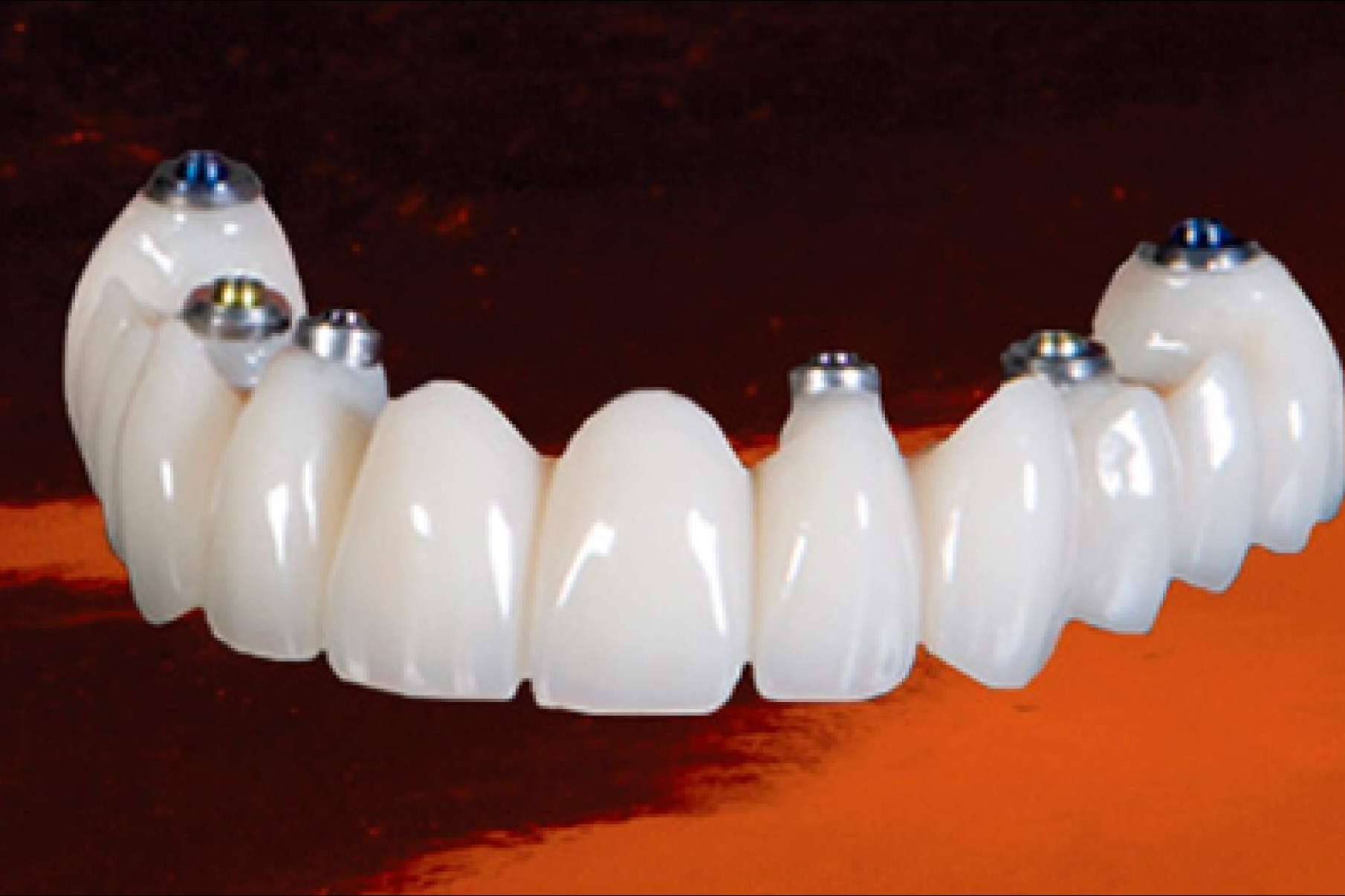 Dental Implantologie cuenta con un laboratorio propio para el servicio de estética dental y ortodoncia invisible