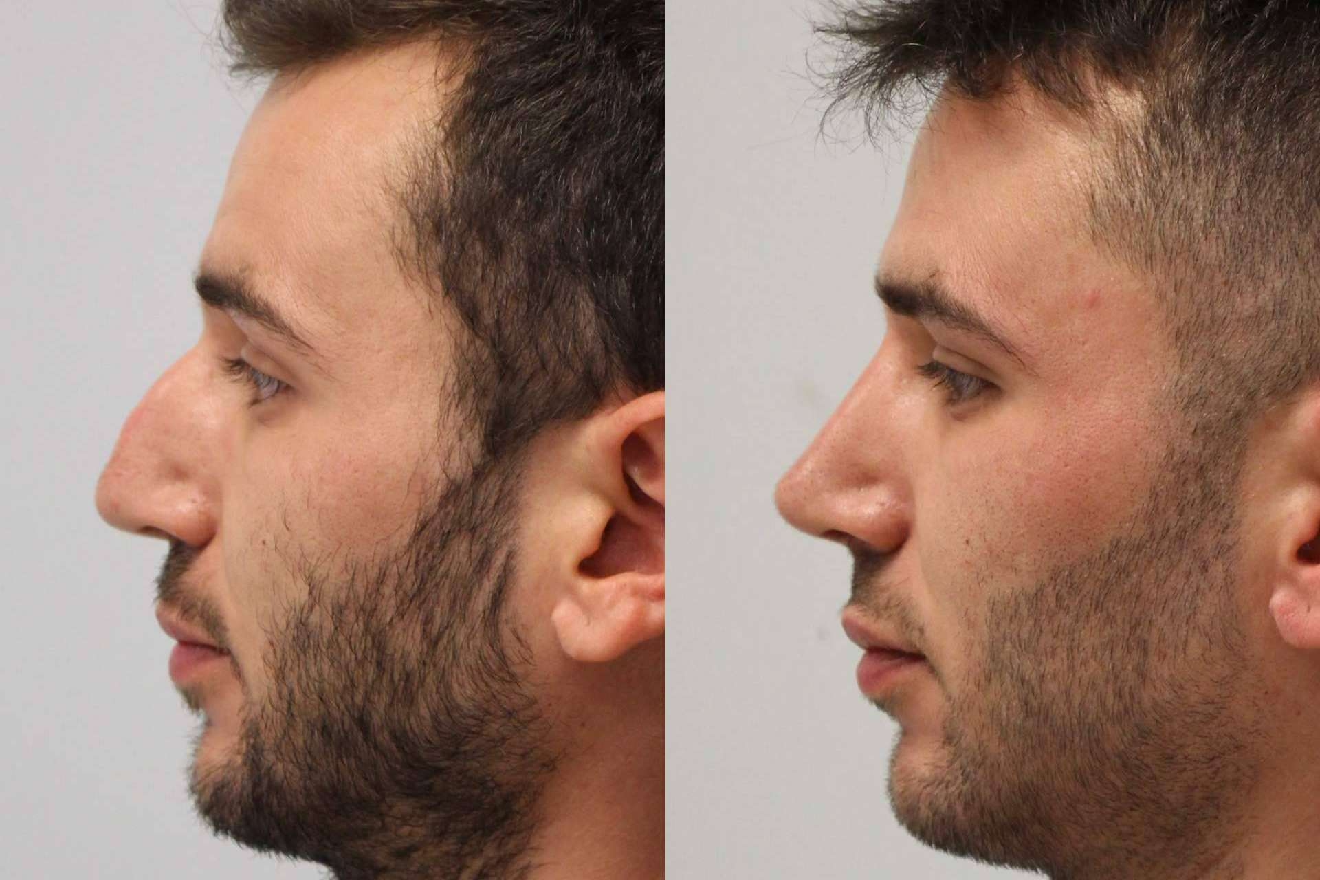 La rinoplastia ultrasónica, un avance médico que está disponible en Valladolid y Santander