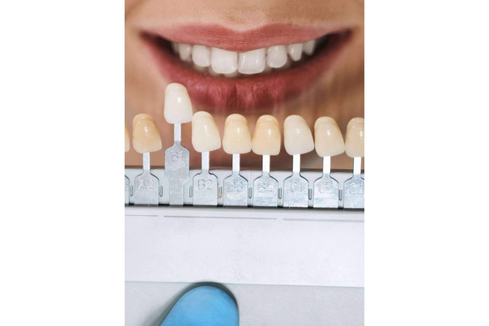 Las carillas dentales, un tratamiento estético dental muy demandado