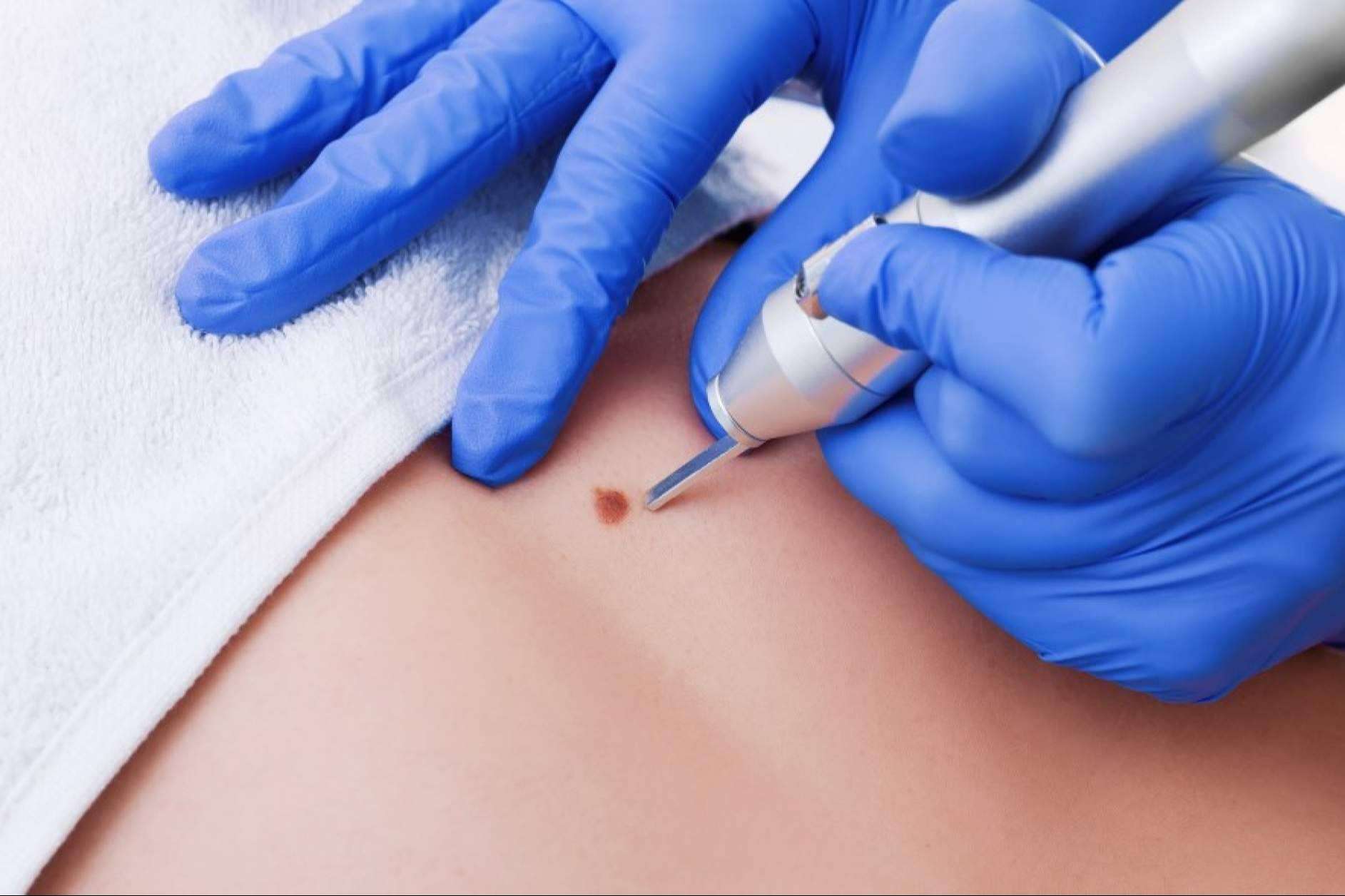 El Centro Médico El Pilar elimina verrugas y lunares con tecnología de vanguardia