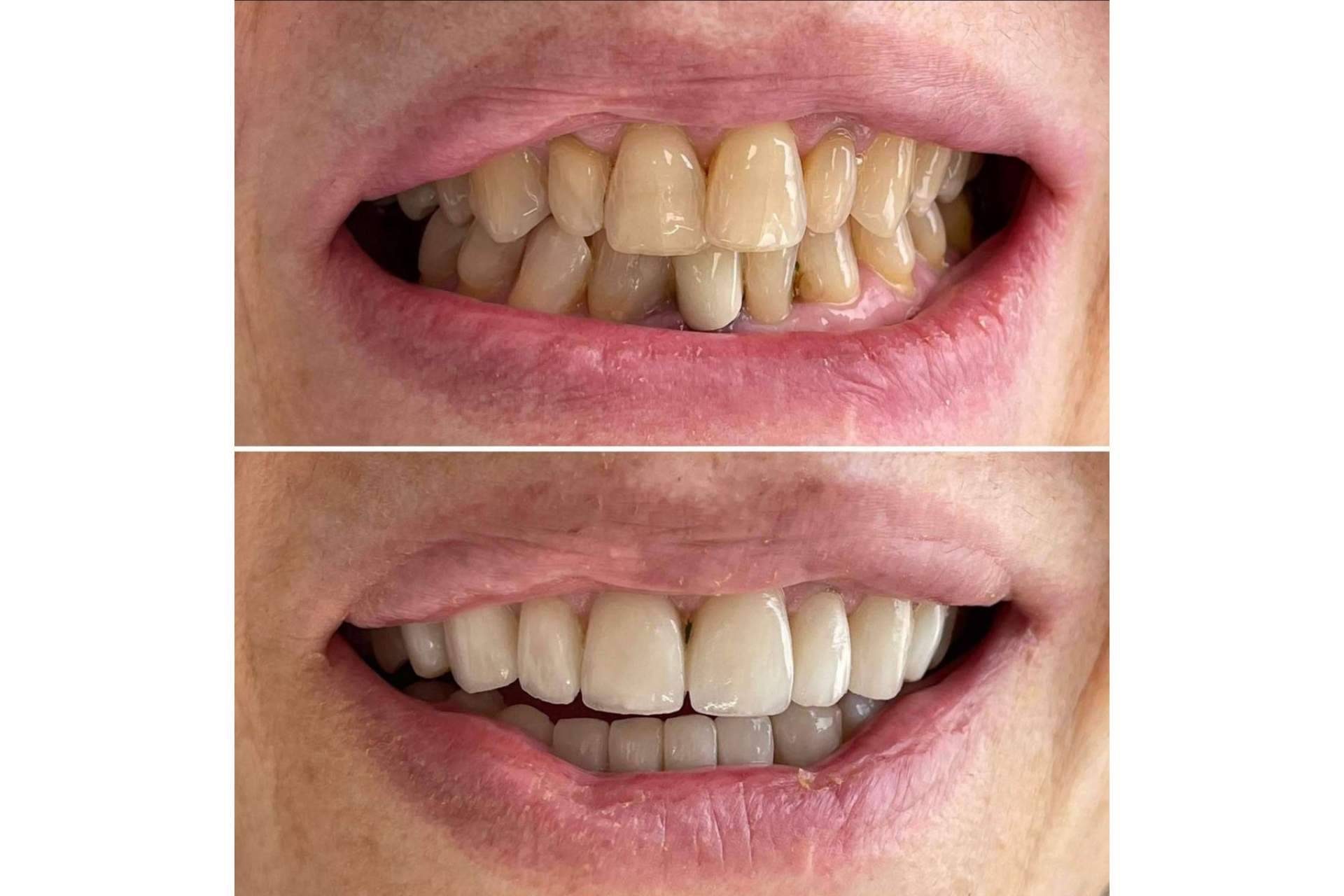 Todo lo que se debe saber acerca de las microcarillas dentales, por Clínica MG Dental & Estética Facial