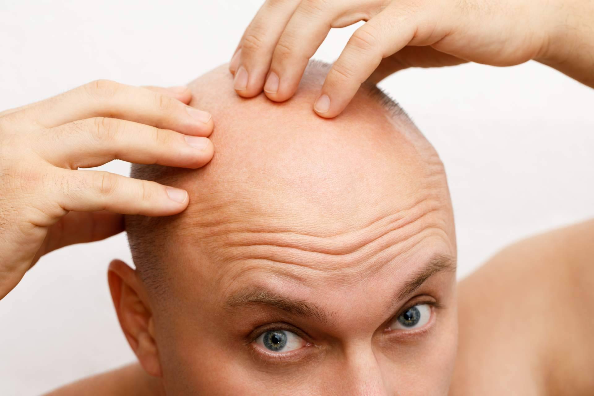 Clínicas Élite Capilar, expertos en el implante de pelo