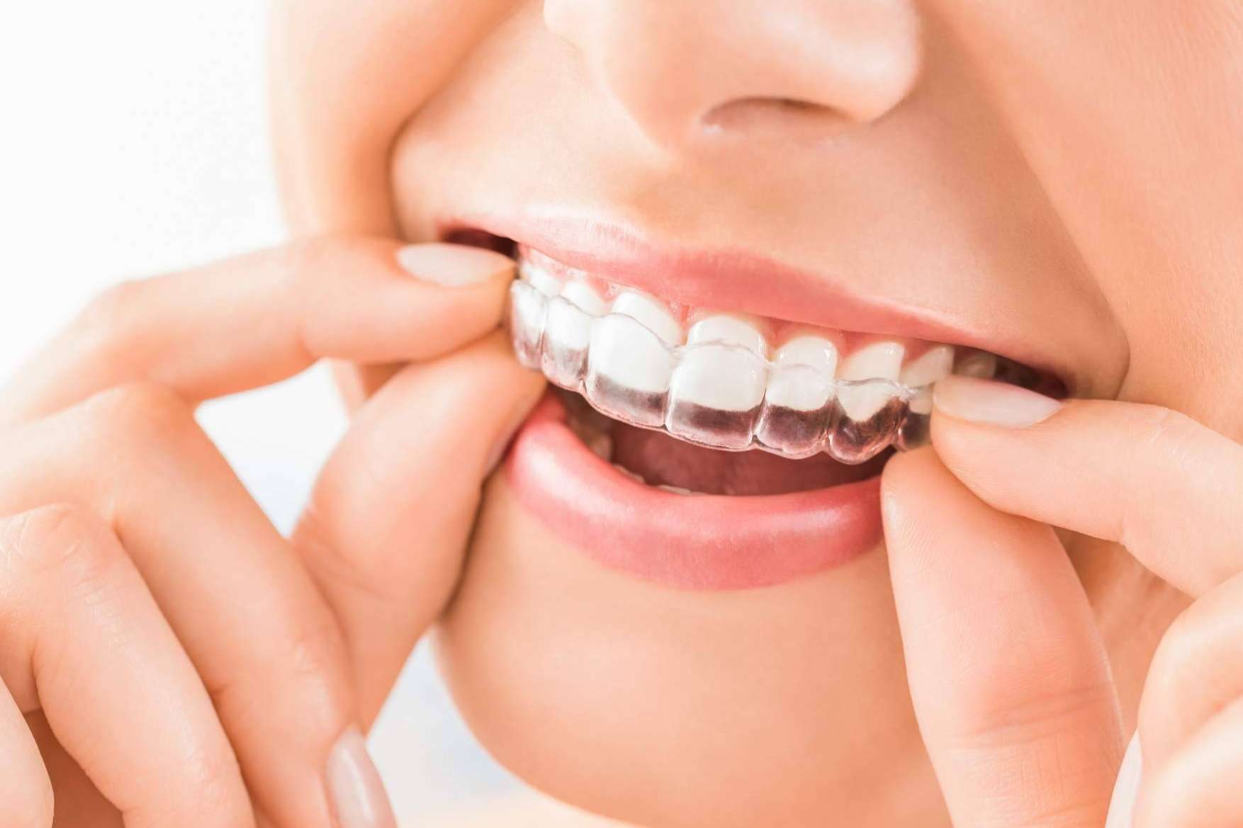Corregir la sonrisa de forma estética con Invisalign en Sevilla, de la mano de Clínicas Dental Bell