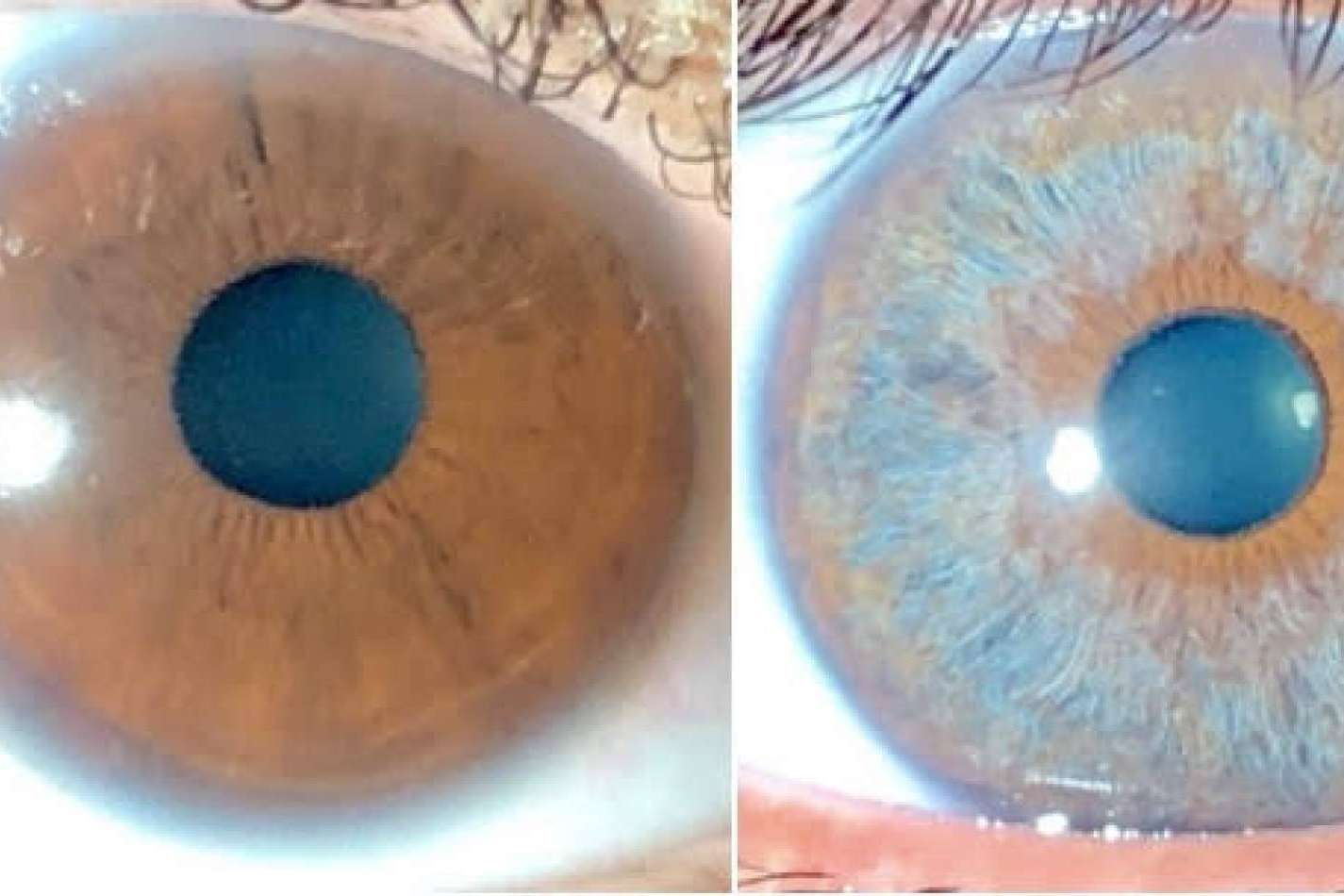 Clínica Eyecos y los avances en las operaciones de cambio de color de ojos con láser