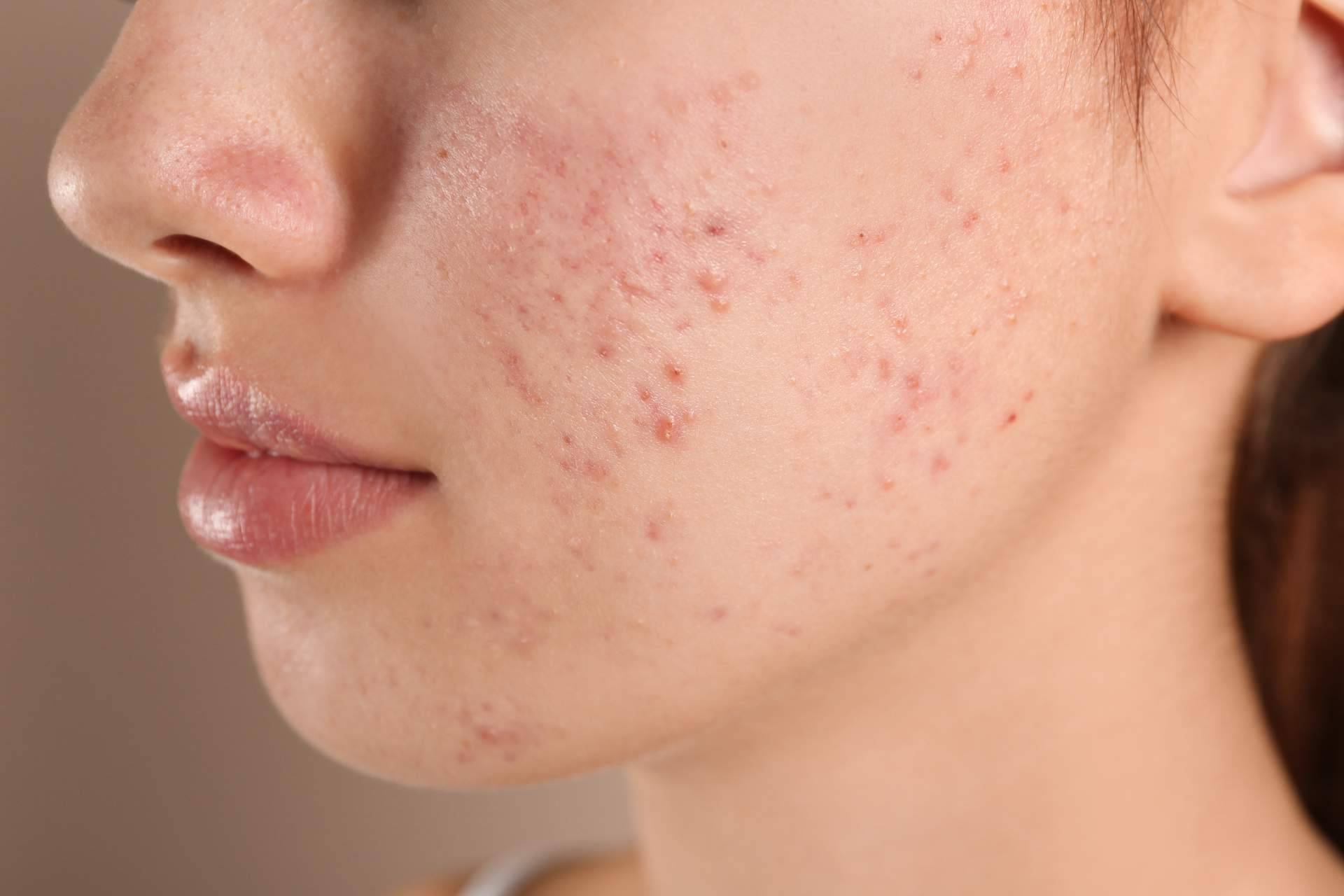 Tratamiento de cicatrices de acné con radiofrecuencia fraccionada con microagujas, de la mano de Alluring Clinic