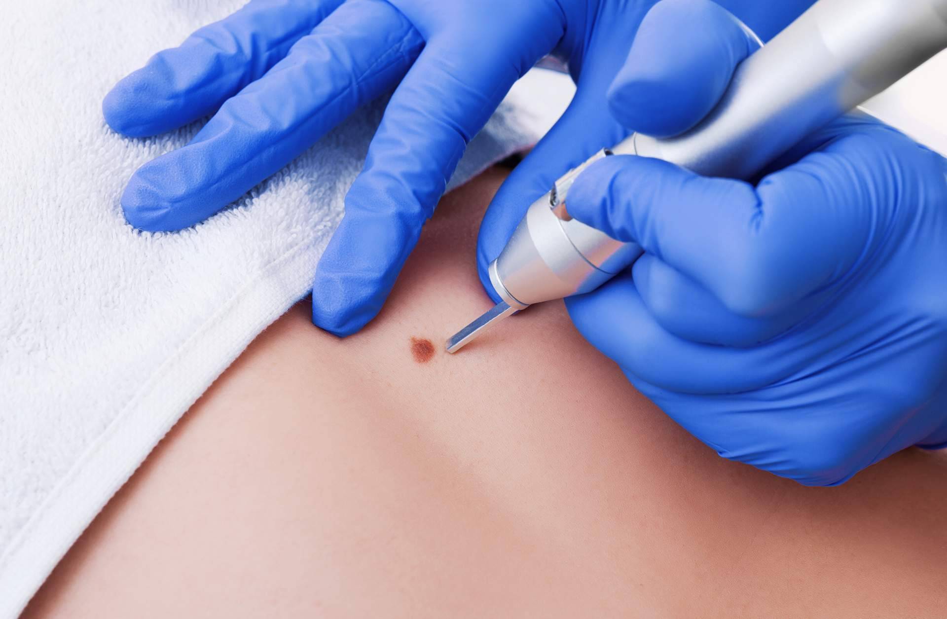 Eliminación de lunares y verrugas con los tratamientos más innovadores en Centro Estética El Pilar