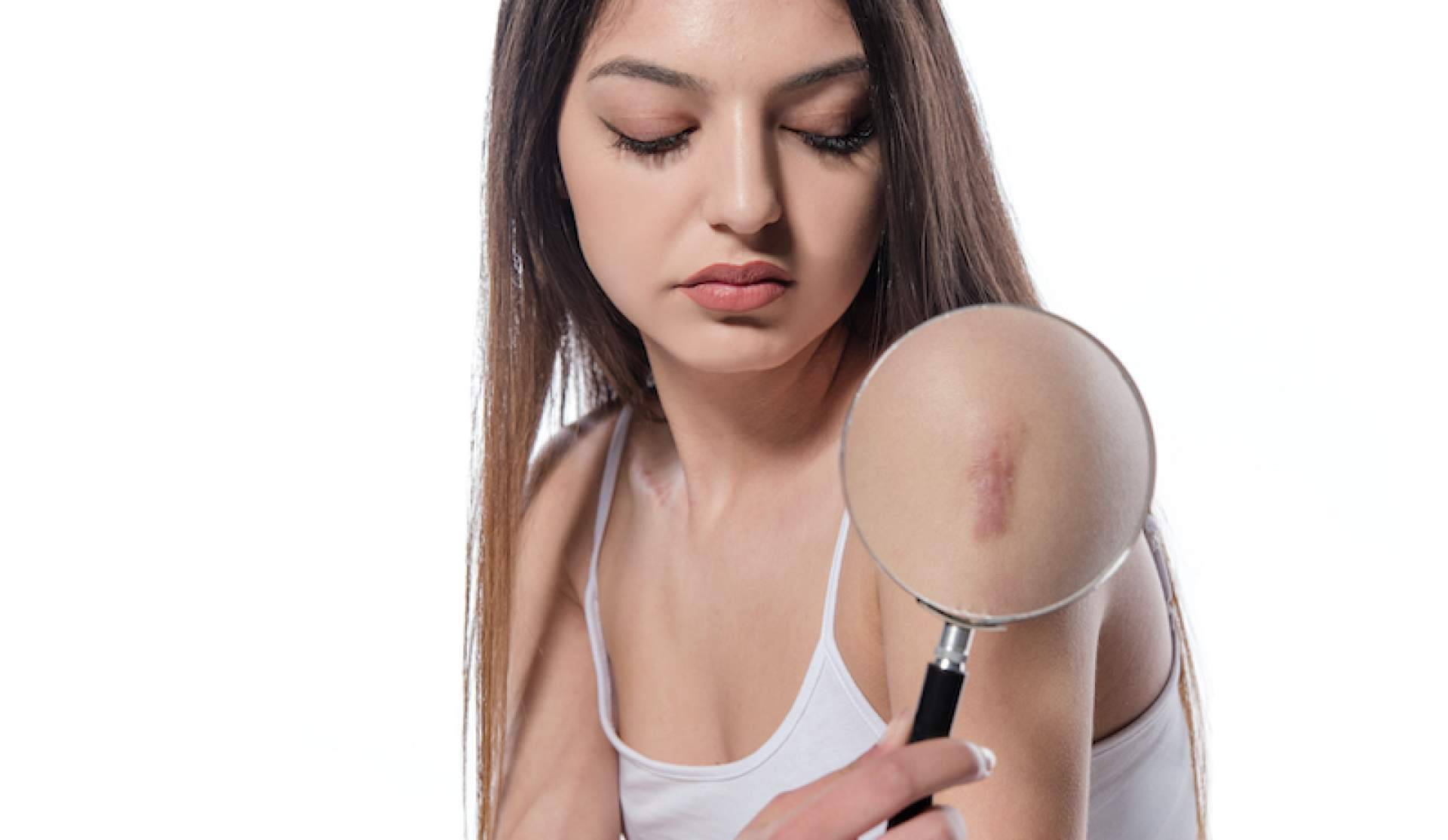 ¿Cuáles son las ventajas de usar tratamientos para eliminar cicatrices?, por Centro Estética el Pilar