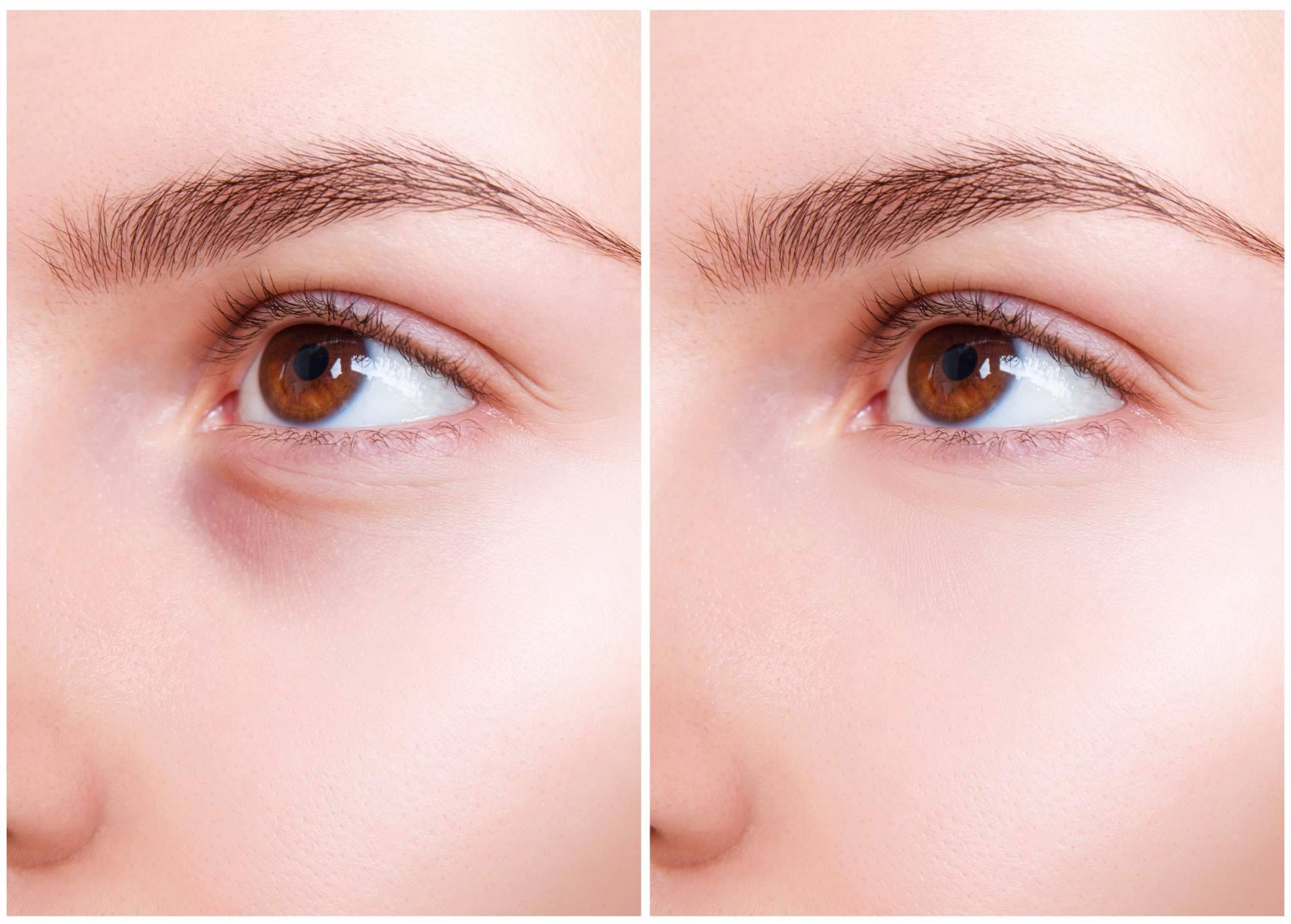 Eliminación de ojeras con ácido hialurónico, de la mano de Centro Médico El Pilar