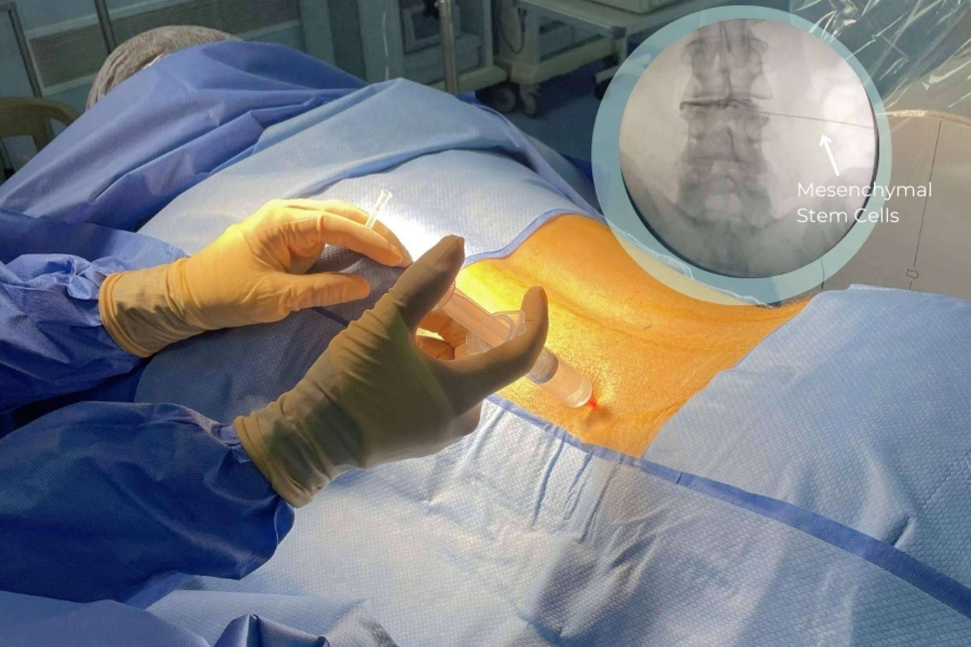 Tratamientos avanzados con resultados duraderos para la hernia de disco, de la mano de Immunotherapy Regenerative Medicine
