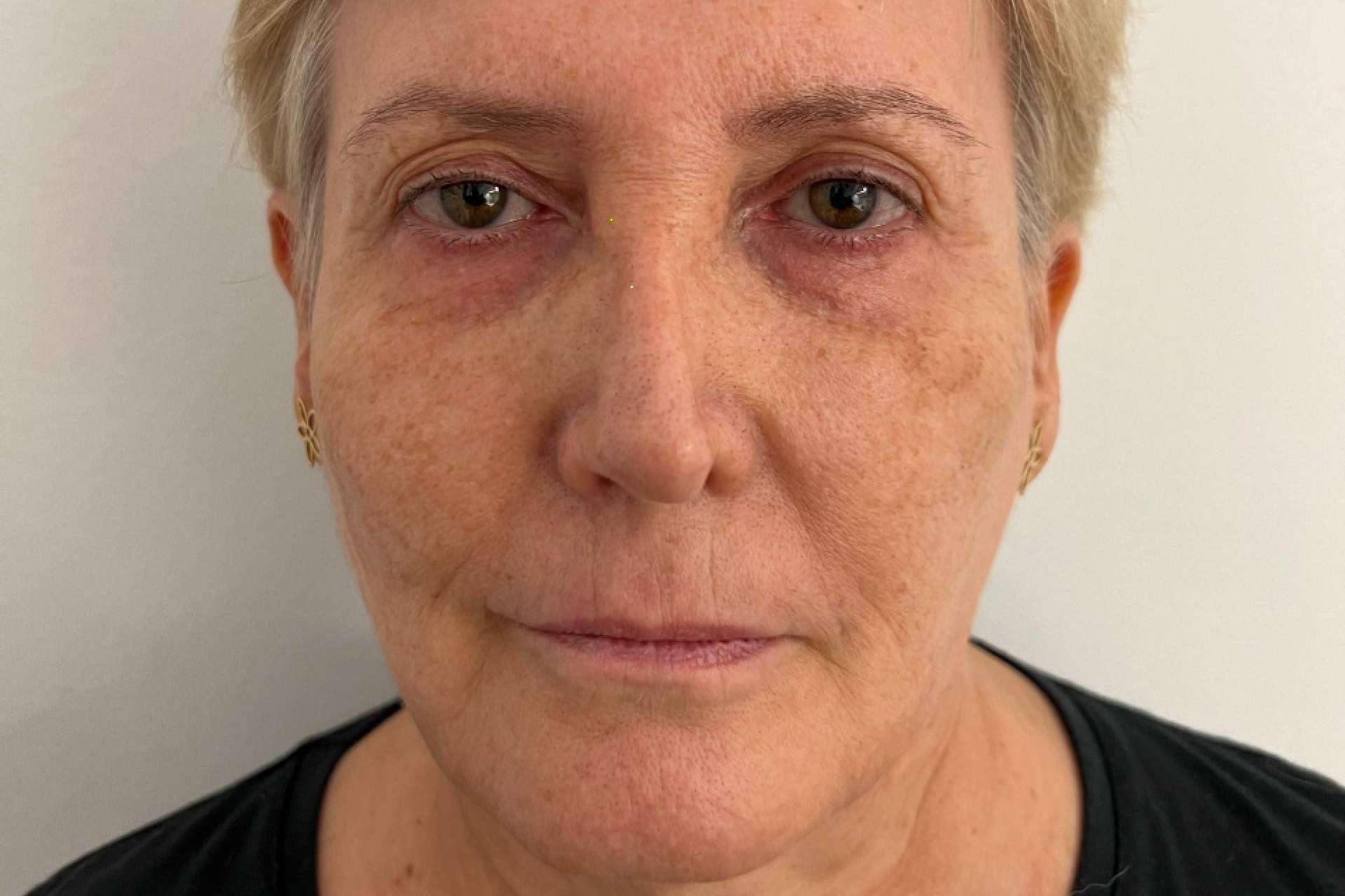 Rejuvenecimiento facial en MD Cliniques; la revolución de SEFFILLER®️ y la regeneración celular autóloga