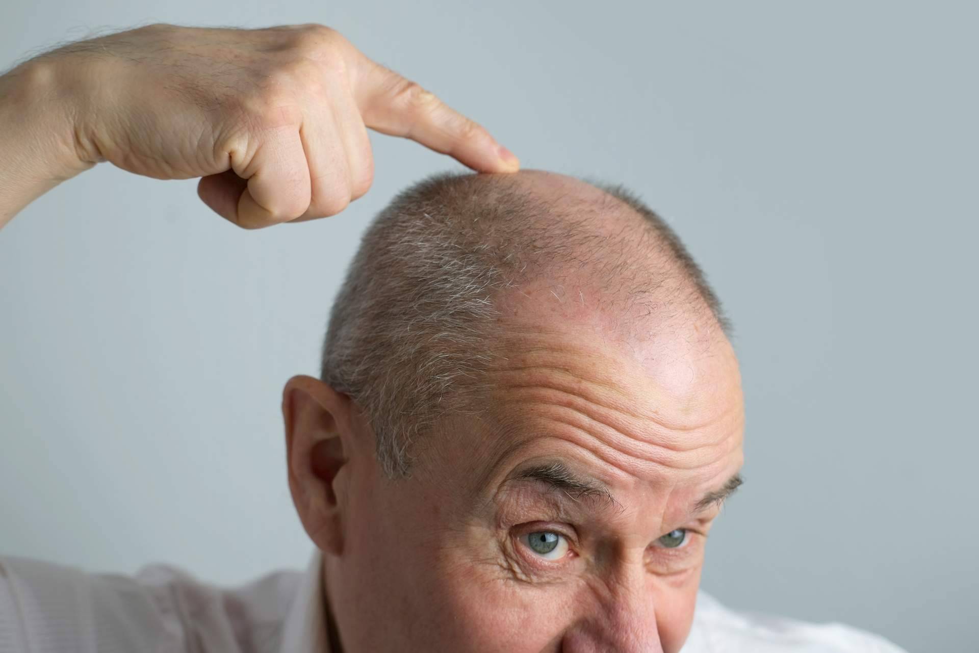 Xpecia Hombre, el aliado nutricional contra la alopecia androgénica disponible en HairFluencer
