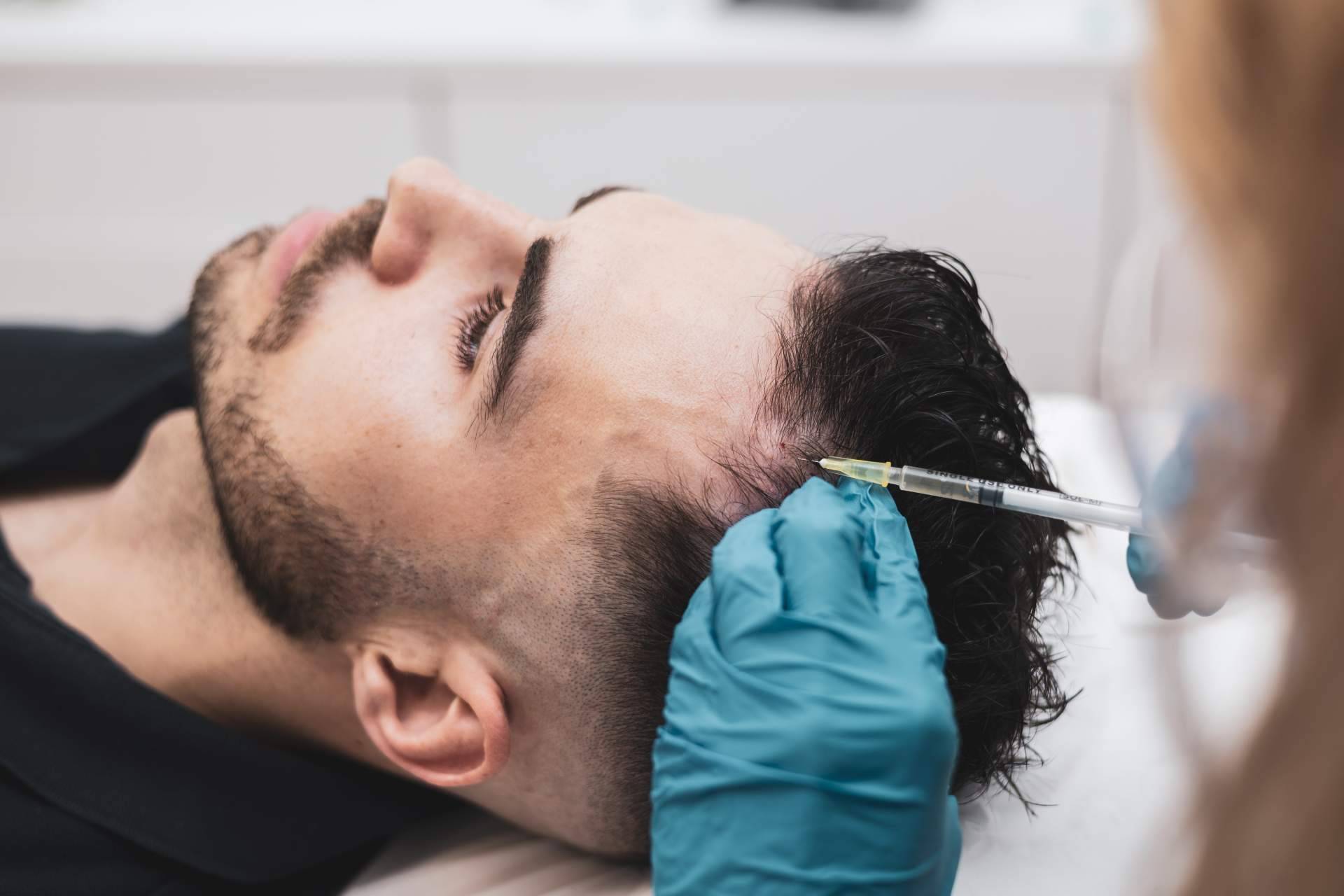 La mesoterapia capilar se abre paso como complemento al trasplante capilar en casos de pérdida de cabello